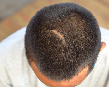 Gynecomastia Surgery